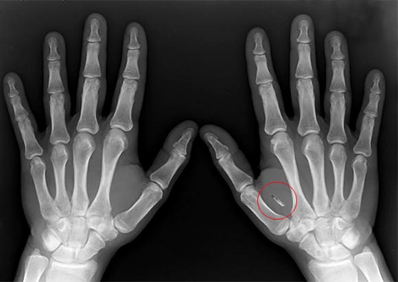 X-Ray Hands implant